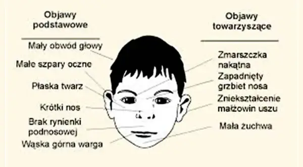 Ilustracja przedstawia twarz dziecka z zaznaczonymi cechami charakterystycznymi dla zespołu FAS: mały obwód głowy, płaska twarz, krótki nos, wąska warga, zmarszczka nakątna, zapadnięty grzbiet nosa.