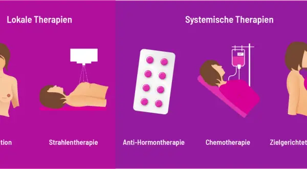 Illustration zeigt lokale und systemische Therapien bei Brustkrebs: Operation, Strahlentherapie, Hormontherapie, Chemotherapie, zielgerichtete Therapie.