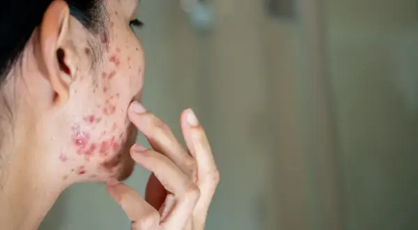 Skóra z widocznym trądzikiem, dotykana palcem. Problemy z cerą mogą być związane z gospodarką hormonalną, w tym z wpływem androgenów na trądzik.