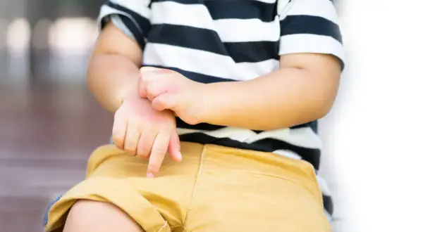 Dziecko w pasiastej koszulce i żółtych spodenkach nerwowo drapie się po ręce.