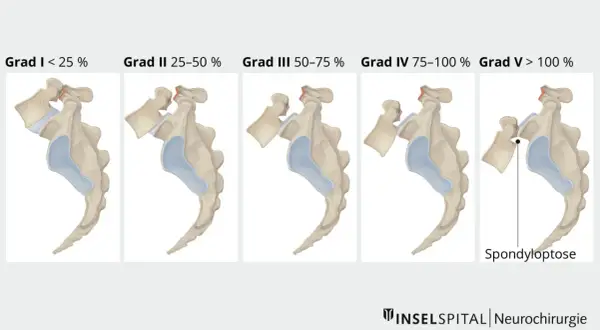 Illustrationen zeigen fünf Grade der Spondyloptose, von Grad I (<25%) bis Grad V (>100%), die den **Meyerding Grad 1 Behinderungsgrad** und weitere Stufen darstellen.