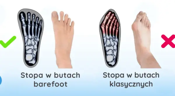 Haluksy: Geny czy buty? Odkryj prawdziwe przyczyny deformacji