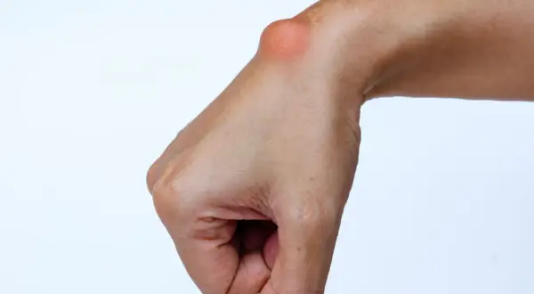 Polso con cisti da sforzo mano, un rigonfiamento visibile sulla parte superiore del polso, indice di un problema legato all'uso eccessivo.