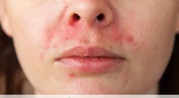 Primo piano del volto di una persona con arrossamenti e piccole pustole, indicativi di dermatite faccia.