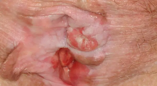 Nahaufnahme der Vulva mit Hautveränderungen, die auf ein Anfangsstadium Vulvakarzinom hindeuten. Rötliche, erhabene Läsionen sind sichtbar.