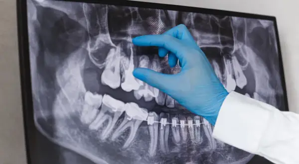 Dentysta w niebieskiej rękawiczce wskazuje na zdjęcie RTG zębów, analizując sytuację przed powtórnym leczeniem kanałowym.