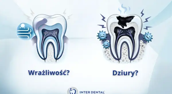 Wrażliwość zęba przy dotyku? Zobacz, jak próchnica niszczy ząb, powodując ból.