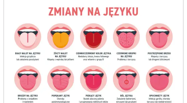 Skuteczne sposoby na pryszcz na języku – jak się pozbyć bólu i dyskomfortu