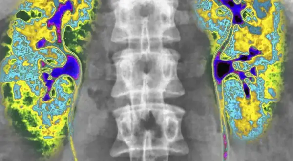 Scyntygrafia kości: kolorowe plamy na tle kręgosłupa, wskazujące na aktywność metaboliczną tkanki kostnej.