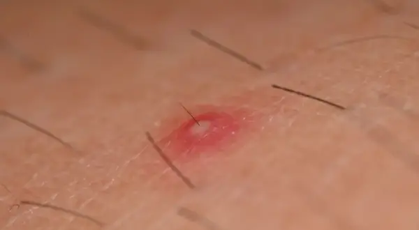 Widoczne pryszcze na karku, z widocznym włosem przebijającym przez jeden z nich. Skóra jest zaczerwieniona i lekko podrażniona.