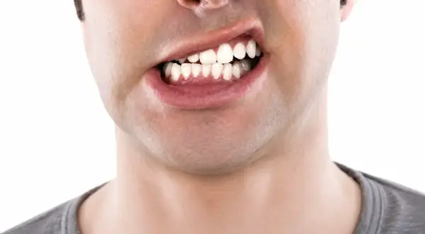 Primo piano di un uomo con denti visibili, che mostra una possibile malocclusione dentale adulti.