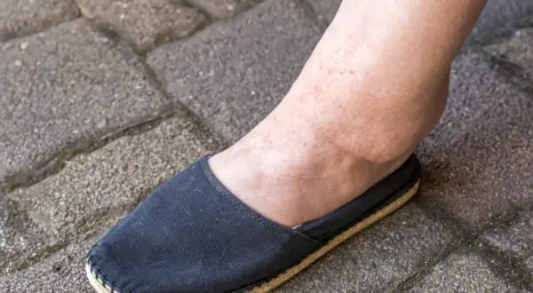 Obrzęk kostki, jeden z objawów marskości nerki, widoczny na nodze w czarnym bucie na tle kostki brukowej.