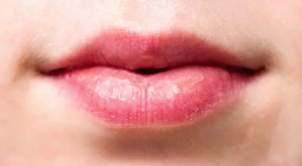 Labios rosados con piel seca y descamada, evidencia de labios quemados por el sol tras un día soleado.