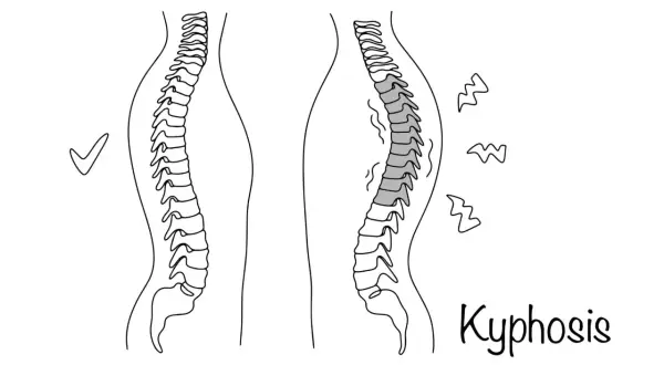 Confronto tra colonna vertebrale sana e cifosi. La cifosi causa posture curve, rendendo le persone gobbe.