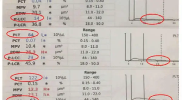 Wyniki badań krwi z zaznaczonymi parametrami P-LCC i P-LCR. Wartości P-LCR są w normie.