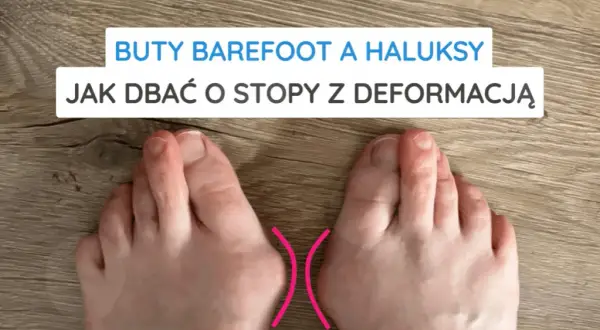 Co na haluksy? Sprawdzone sposoby na ból i trwałe rozwiązanie