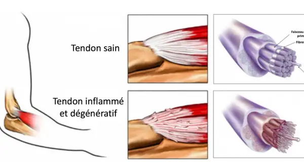 Comparaison d'un tendon sain et d'un tendon inflammé, montrant les fibres déchirées typiques du tennis elbow.