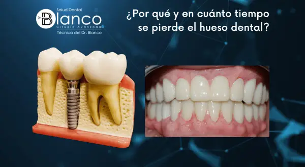 Modelo de implante dental y encías sanas. La imagen aborda la **pérdida hueso dental** y su tiempo.