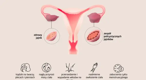 Zaburzenia hormonalne jajników: objawy, diagnoza i pomoc