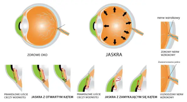 Od czego jest jaskra? Poznaj przyczyny i ryzyko tej choroby oczu