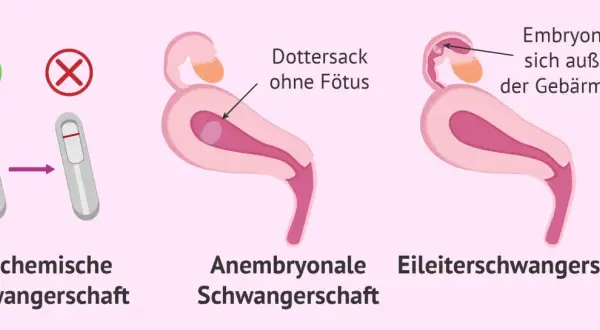 Anzeichen für eine Fehlgeburt: Biochemische Schwangerschaft, Dottersack ohne Fötus, Embryo nistet sich außerhalb der Gebärmutter ein.