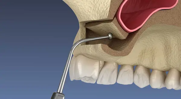 Ilustración de elevación de seno maxilar, mostrando el instrumento dental y la anatomía ósea.