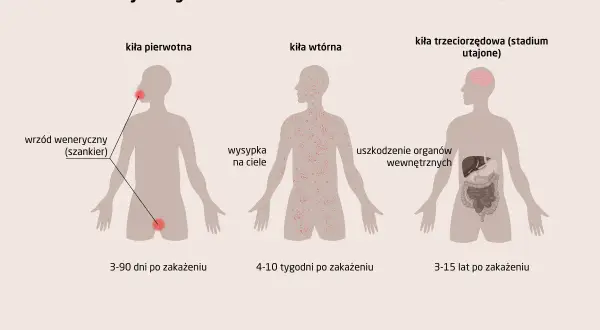 Ilustracja przedstawia stadia rozwoju kiły: pierwotne (wrzód), wtórne (wysypka) i trzeciorzędowe (uszkodzenie organów).