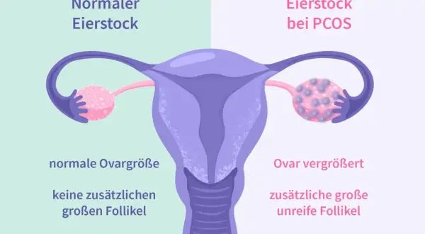 Porównanie jajnika: normalny vs. przy PCOS. Zwiększony jajnik z licznymi niedojrzałymi pęcherzykami to jeden z objawów PCOS.