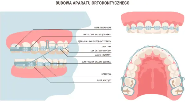 Aparat ortodontyczny: Kiedy zacząć i jakie warunki musisz spełnić?
