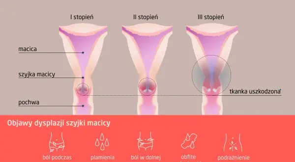 Ilustracja przedstawia stadia dysplazji szyjki macicy: I, II i III stopień, z zaznaczoną tkanką uszkodzoną w III stadium. Poniżej objawy: ból, plamienia, obfite miesiączki.