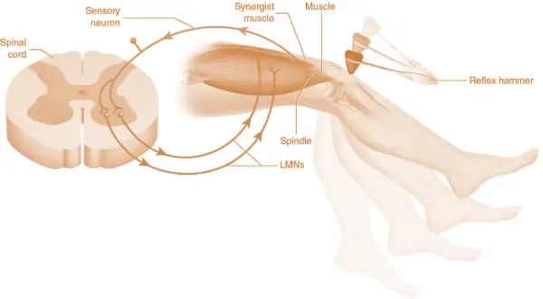 Schema del riflesso patellare. Un martelletto colpisce il ginocchio, causando un'estensione rapida dovuta all'ipertonia muscolare.