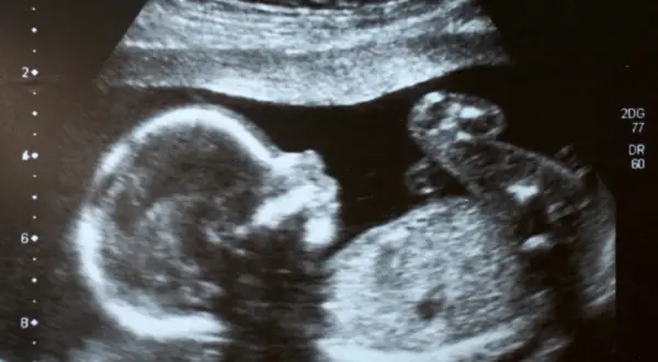 Ultraschallbild eines Babys. Die detaillierte Aufnahme zeigt das Gesicht und den Körper des Kindes, was beim Ultraschall zur Geschlechtsbestimmung hilfreich ist.