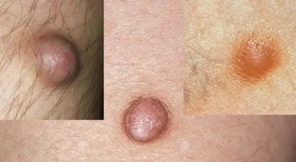 Nahaufnahme von Hautveränderungen, die auf fibrose Hautbilder hinweisen. Kleine, erhabene Knötchen auf der Haut.