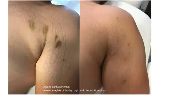 Przed i po karboksyterapii: widoczne zmniejszenie rozstępów i siniaki po zabiegu. Karboksyterapia efekty widoczne na skórze.
