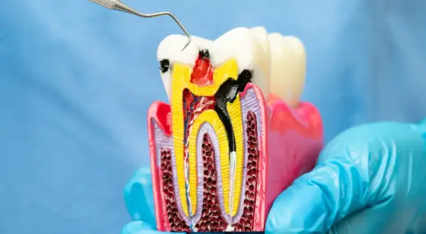 Model zęba pokazuje, co to endodoncja: leczenie kanałowe zniszczonej miazgi.