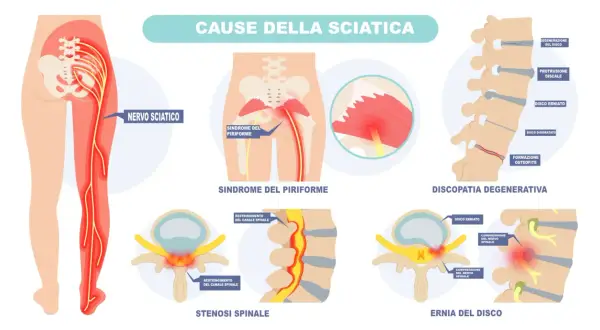 Illustrazione delle cause della sciatica: sindrome del piriforme, discopatia degenerativa, stenosi spinale ed ernia del disco che comprimono il nervo sciatico.