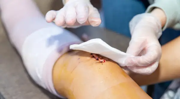 Opatrunek na ranie po operacji. Witamina C, witamina odpowiadająca za gojenie się ran, jest kluczowa dla regeneracji skóry.