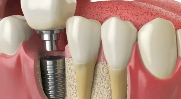 Przekrój szczęki ukazujący implant zęba, jego mocowanie i koronę. Warto znać potencjalne implant zęba powikłania.