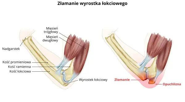 Ilustracja pokazuje złamanie wyrostka łokciowego, z zaznaczoną opuchlizną i miejscem złamania.