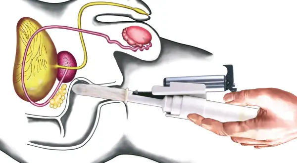 Illustration zeigt eine rektale Untersuchung mit einem Instrument, das in den After eingeführt wird, um die Prostata zu untersuchen.