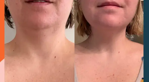 Before and after neck training: The left image shows a softer jawline and neck, while the right image displays a more defined jawline and smoother neck.