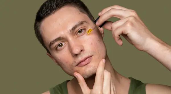 Mężczyzna aplikuje serum na twarz z widocznymi niedoskonałościami, takimi jak wyciskanie pryszczy i głębokie zaskórniki.
