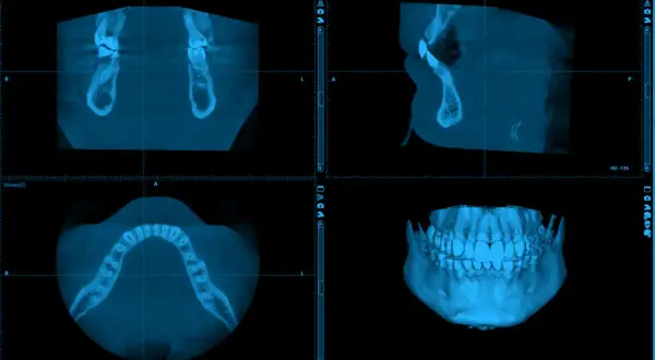 Trzy widoki tomografii komputerowej szczęki i żuchwy. Widok osiowy pokazuje łuk zębowy. Ile kanałów ma 7 zębów? To pytanie dla dentysty.