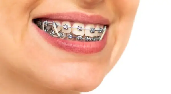 Sorriso con apparecchio ortodontico e elastici intermascellari, per un allineamento perfetto dei denti.