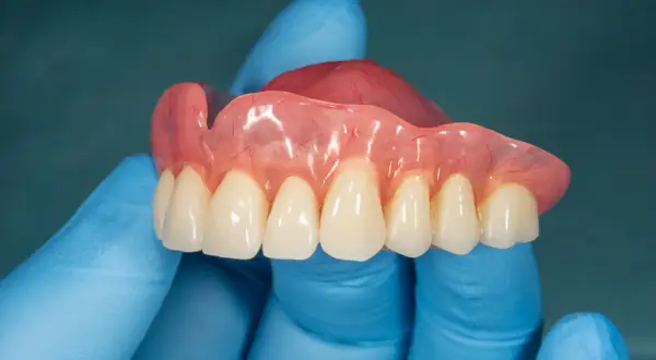 Proteza jednego zęba NFZ, wykonana z różowego akrylu z widocznymi naczynkami, z białymi zębami, trzymana w niebieskiej rękawiczce.