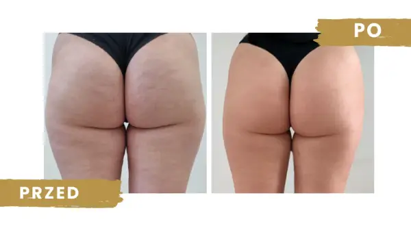 Endermologia: Jak często dla najlepszych efektów? Pełny plan