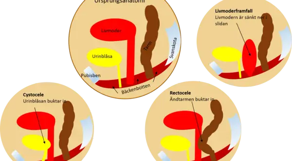 Illustrationer visar hur livmoderframfall, cystocele och rektosele ser ut.