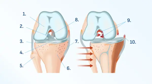 Ilustracja anatomiczna stawu kolanowego, pokazująca zdrową strukturę i uszkodzenie więzadła.