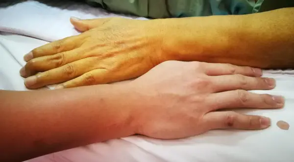 Dwie dłonie na białym tle. Jedna jest wyraźnie żółta, co może wskazywać na żółtaczkę u dziecka.