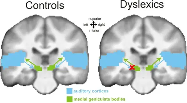 Czy dysleksja to choroba? Prawda o zaburzeniu neurorozwojowym